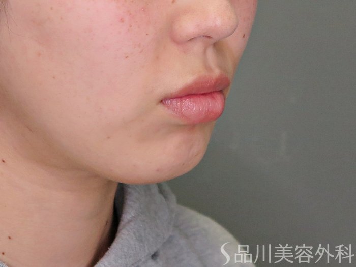 症例NO.71380のBEFORE写真