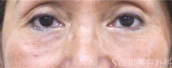 症例NO.12004のAFTER写真