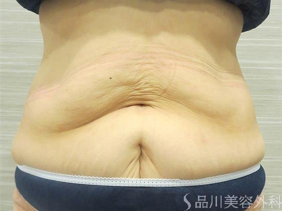 症例NO.20564のAFTER写真