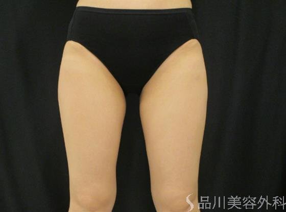 症例NO.46476のAFTER写真