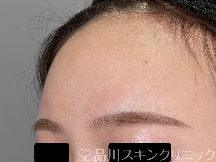 症例NO.70075のAFTER写真
