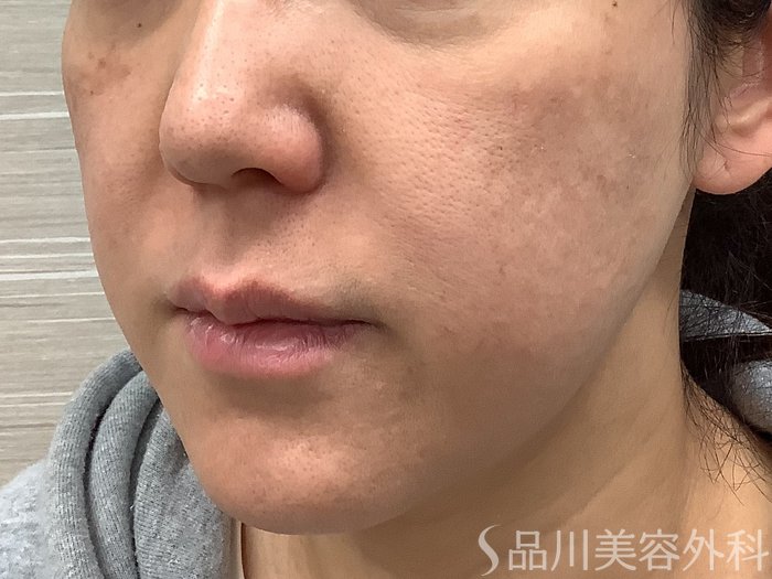 症例NO.62263のBEFORE写真