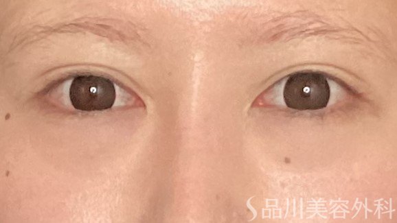 症例NO.65621のBEFORE写真