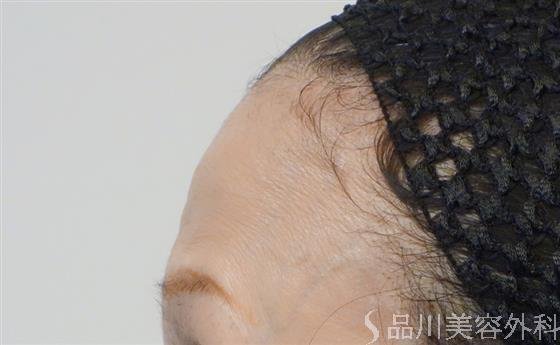症例NO.51172のBEFORE写真