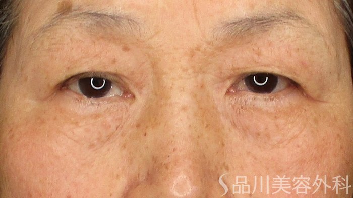 症例NO.70871のBEFORE写真