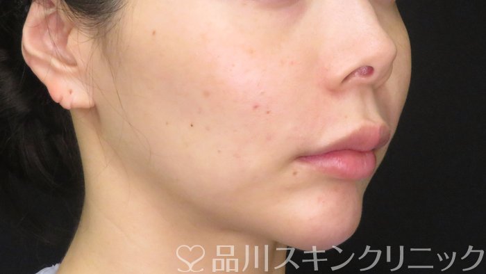 症例NO.70882のBEFORE写真