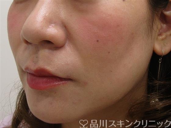 症例NO.45330のBEFORE写真