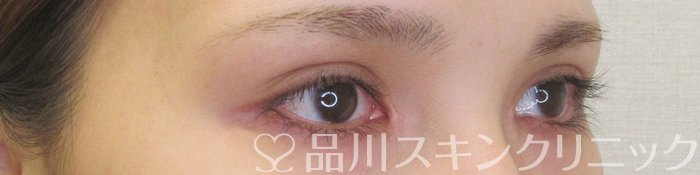 症例NO.70226のAFTER写真