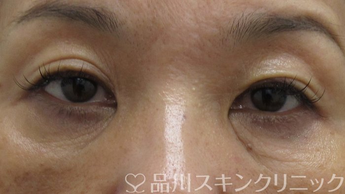 症例NO.74397のAFTER写真