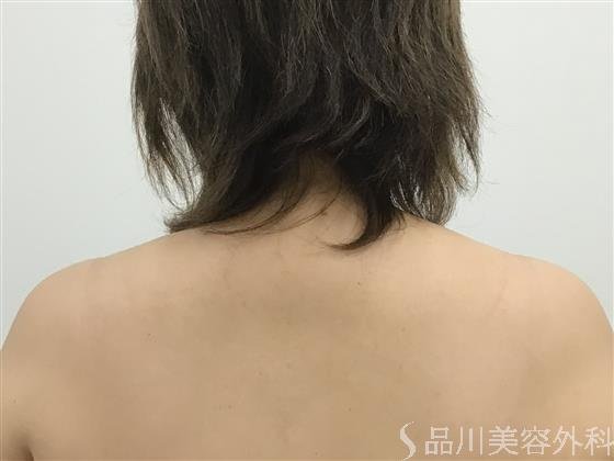 症例NO.59211のBEFORE写真