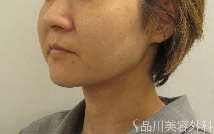 症例NO.70577のBEFORE写真
