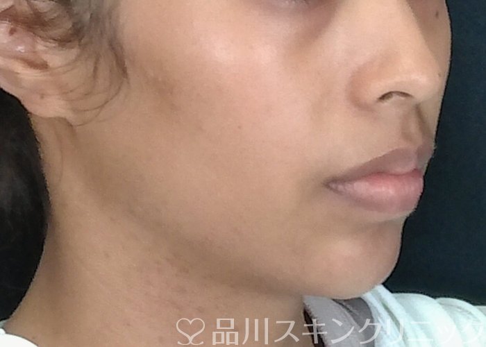 症例NO.70921のAFTER写真