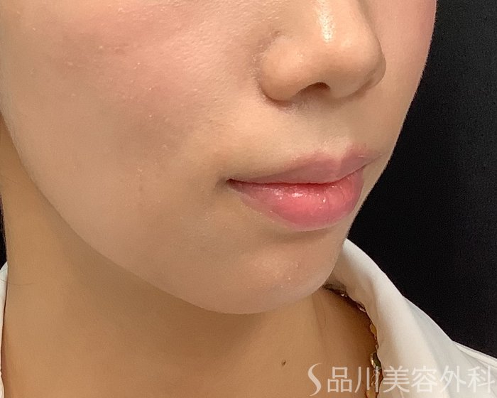 症例NO.75339のBEFORE写真