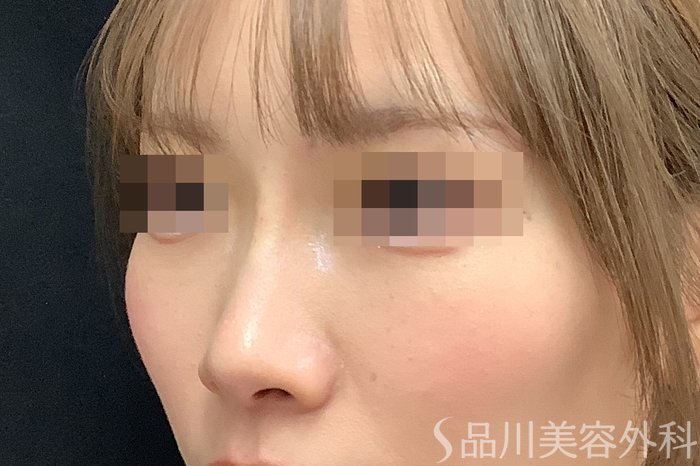 症例NO.71637のAFTER写真