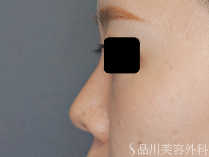 症例NO.70400のAFTER写真