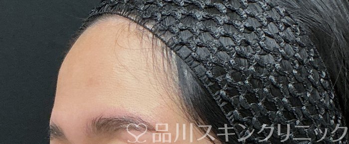 症例NO.74384のBEFORE写真