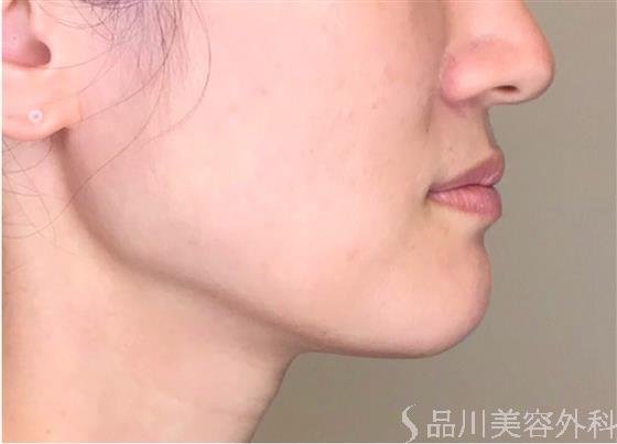 症例NO.50080のAFTER写真