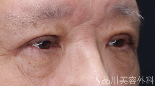 症例NO.74742のAFTER写真