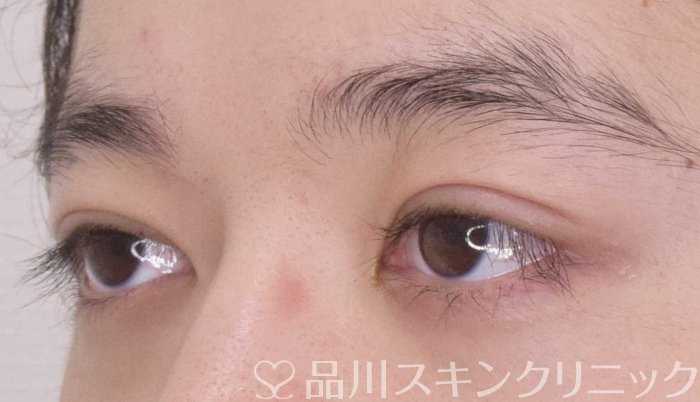 症例NO.64807のAFTER写真