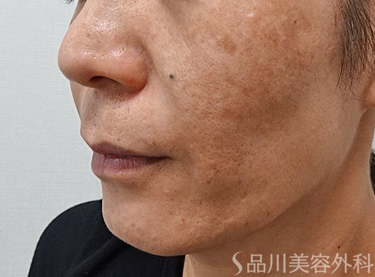 症例NO.65604のAFTER写真