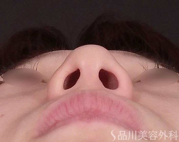 症例NO.69294のBEFORE写真