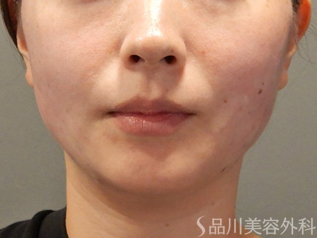 症例NO.71817のAFTER写真