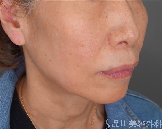 症例NO.54675のBEFORE写真