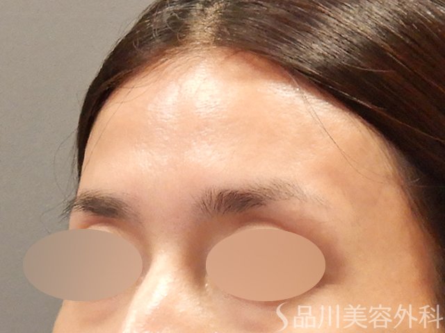 症例NO.71727のBEFORE写真