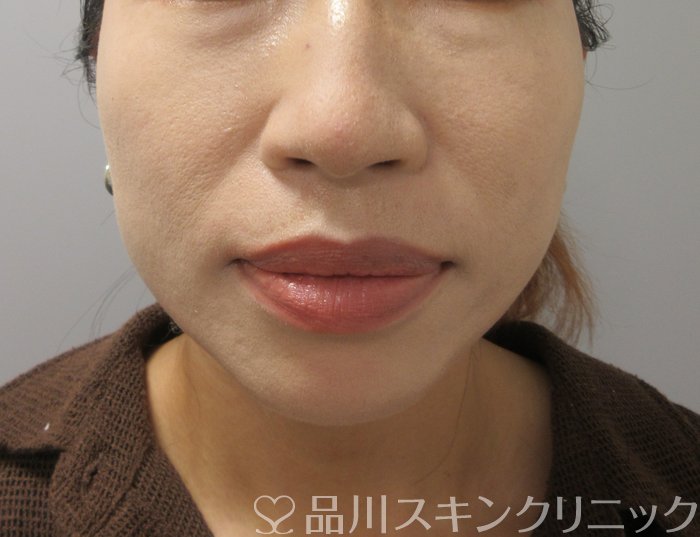 症例NO.74033のAFTER写真