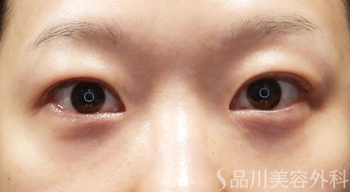 症例NO.70382のAFTER写真