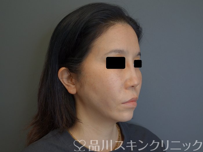 症例NO.75051のAFTER写真