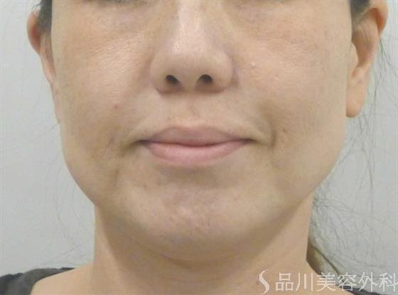 症例NO.39510のBEFORE写真