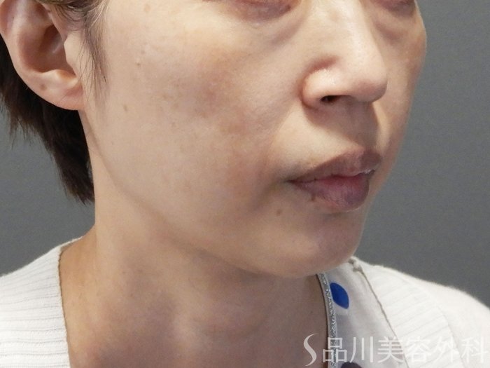 症例NO.72043のBEFORE写真