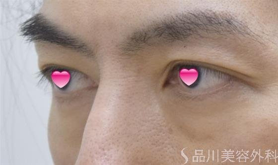 症例NO.51670のBEFORE写真