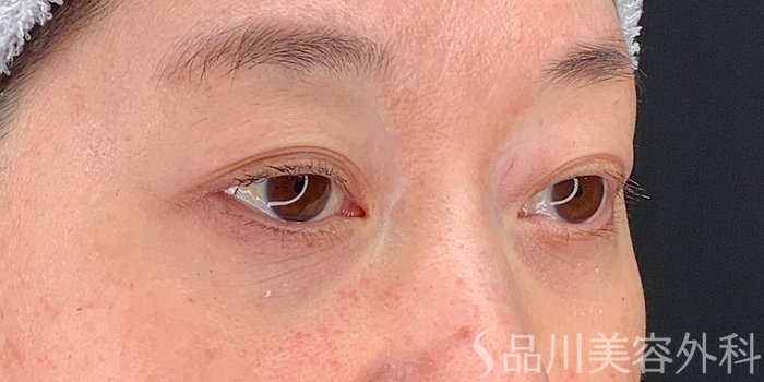 症例NO.71225のBEFORE写真