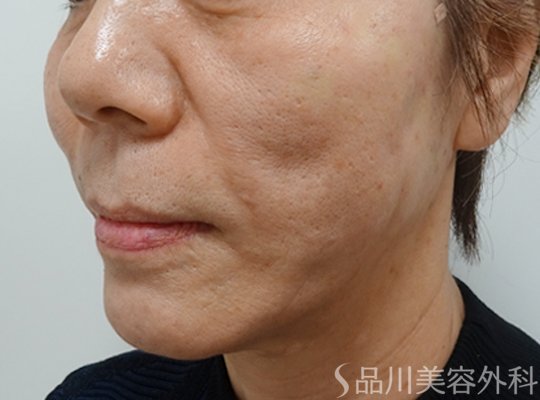 症例NO.71758のAFTER写真