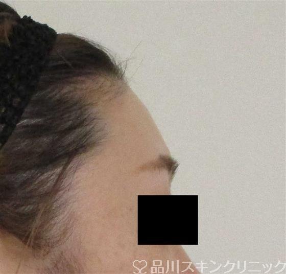 症例NO.61638のBEFORE写真