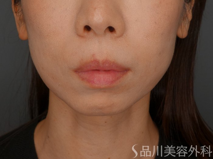 症例NO.74476のBEFORE写真