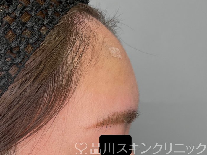 症例NO.70091のAFTER写真