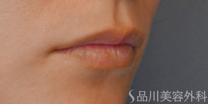 症例NO.71620のBEFORE写真