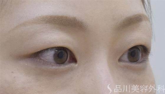症例NO.53301のBEFORE写真