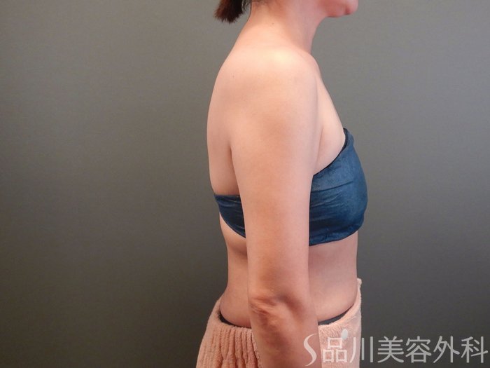 症例NO.65681のAFTER写真