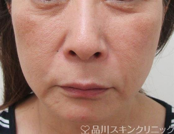 症例NO.30300のAFTER写真
