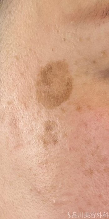 症例NO.72446のBEFORE写真