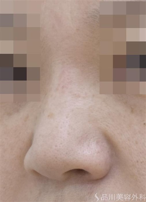 症例NO.48540のBEFORE写真