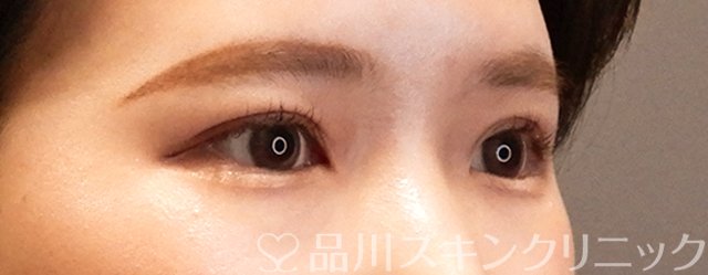 症例NO.70028のAFTER写真