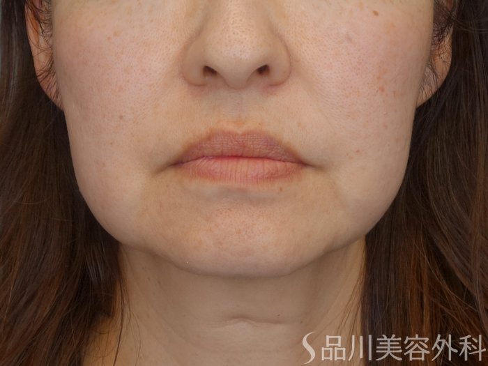 症例NO.70368のBEFORE写真