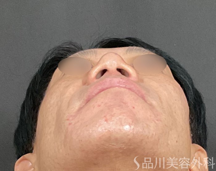 症例NO.74718のBEFORE写真