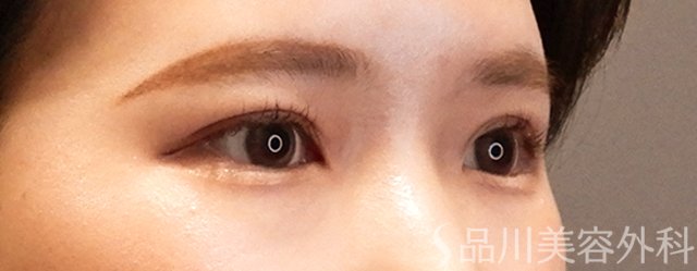 症例NO.70028のAFTER写真
