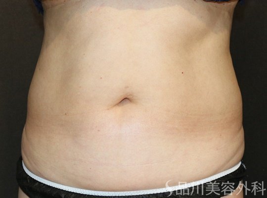 症例NO.73692のAFTER写真